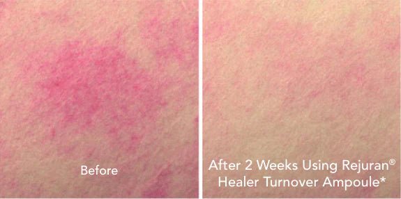 REJURAN Turnover Ampoule 0.5% cPDRN - RIMAN KBeauty - Korean Skincare Routine for Glass Skin